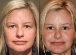 Dr. Michael McCracken's patient shows results of her upper eyelid surgery
